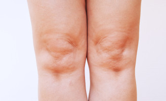 What do I do about my swollen leg?